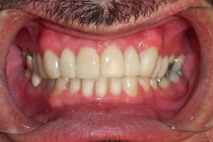 Veneers #4-#13 at cementation appointment