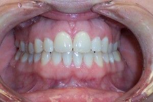 Invisalign after space closure 