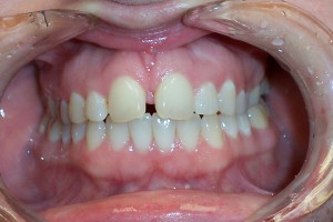 Invisalign clear braces before treatment.