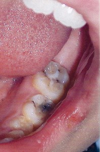 Tooth #19 and #K with dark stained cavities.